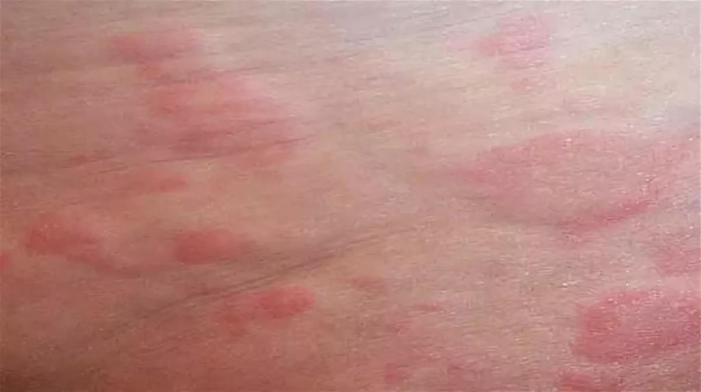 Symptôme de syphilis