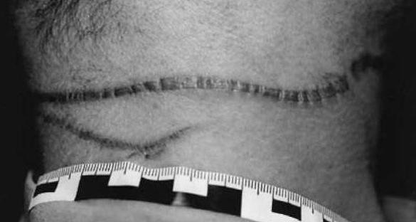 signes de strangulation sillon