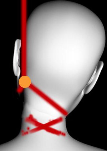 sillon de strangulation lors du retrait de la boucle