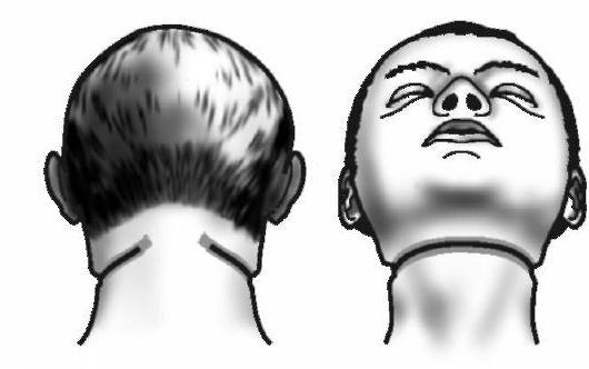 sillon d'étranglement fermé