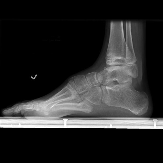 platypodia 2 degrés prennent dans l'armée